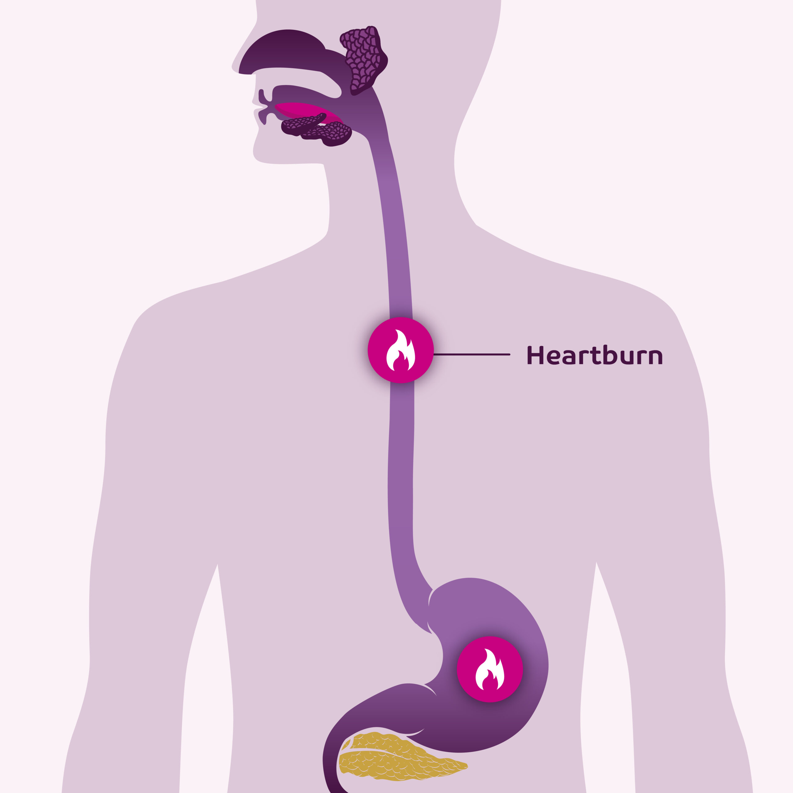 Infographic showing the feeling of heartburn