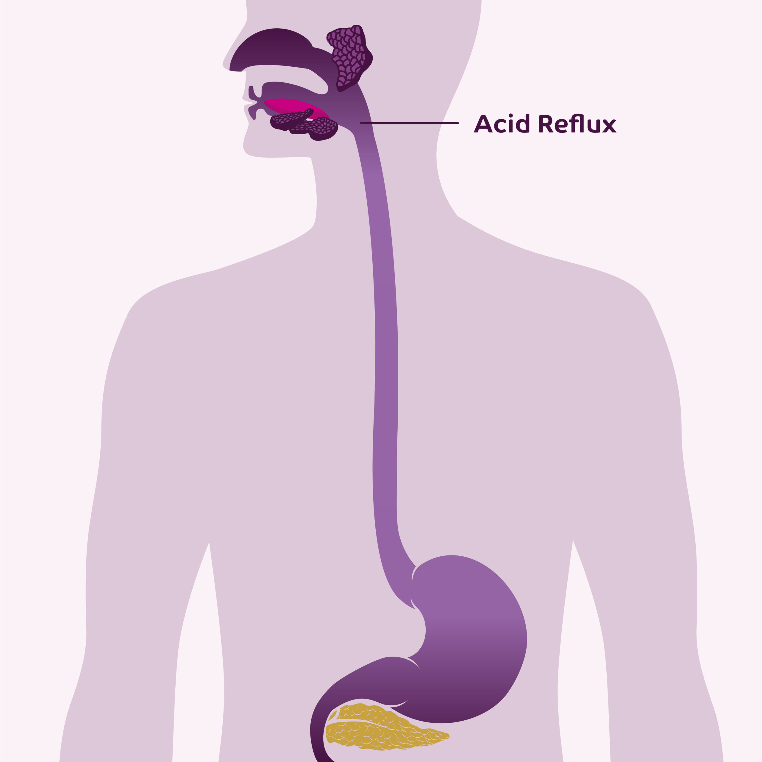 Infographic showing the feeling of acid reflux